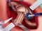 Laro Princess Hips Surgery online