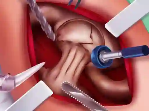 Laro Princess Hips Surgery online